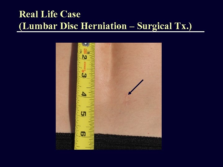 Real Life Case (Lumbar Disc Herniation – Surgical Tx. ) 