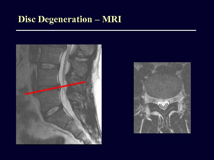 Disc Degeneration – MRI 