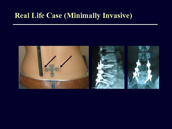 Real Life Case (Minimally Invasive) 