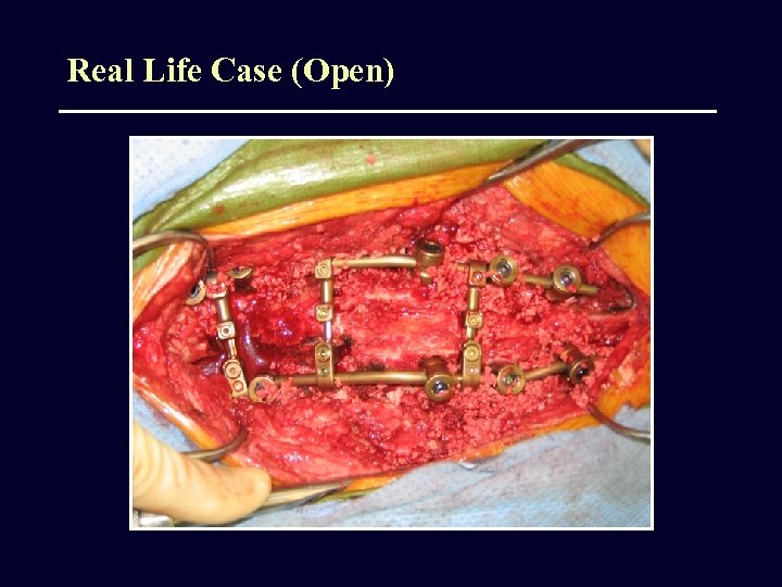 Real Life Case (Open) 