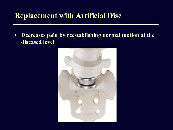 Replacement with Artificial Disc • Decreases pain by reestablishing normal motion at the diseased