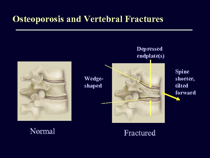 Osteoporosis and Vertebral Fractures Depressed endplate(s) Spine shorter, tilted forward Wedgeshaped Normal Fractured 