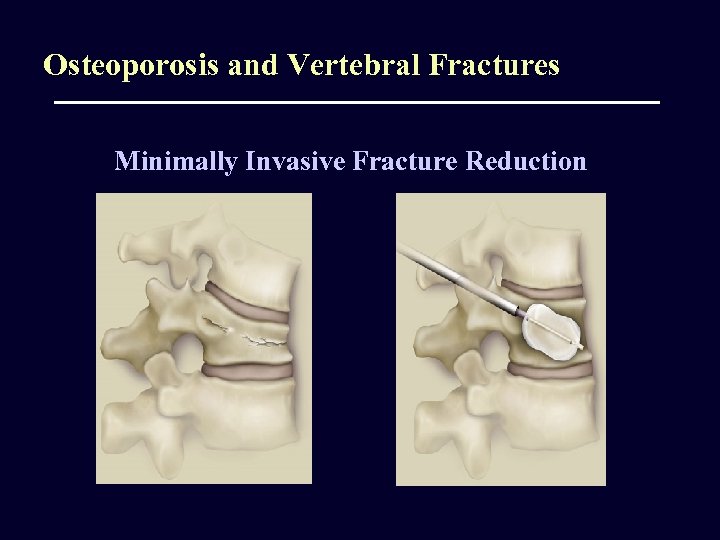 Osteoporosis and Vertebral Fractures Minimally Invasive Fracture Reduction 