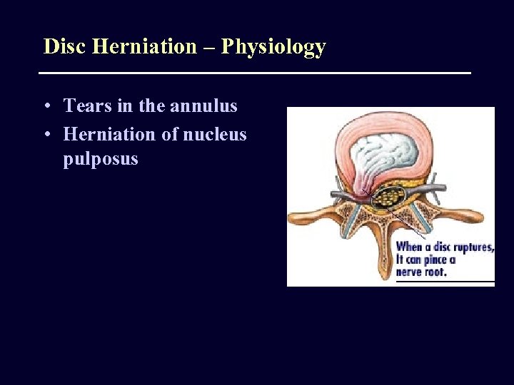 Disc Herniation – Physiology • Tears in the annulus • Herniation of nucleus pulposus