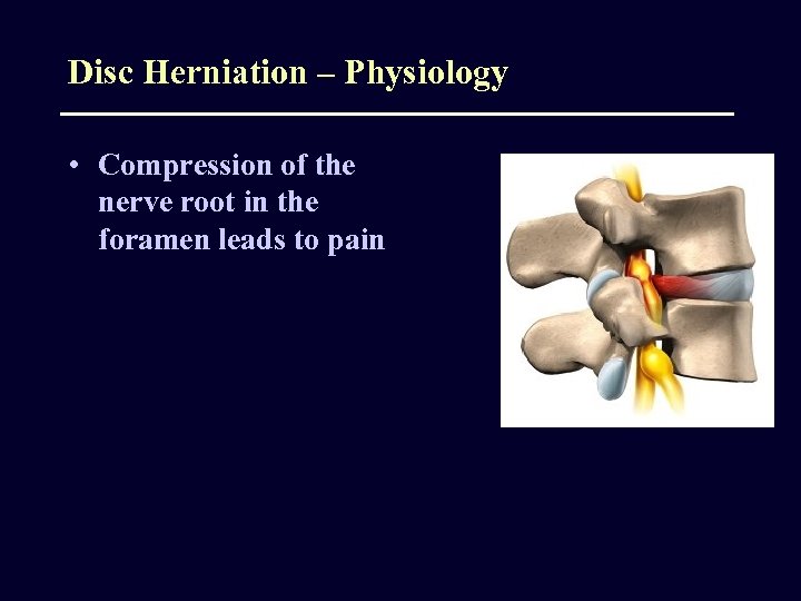 Disc Herniation – Physiology • Compression of the nerve root in the foramen leads