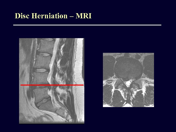 Disc Herniation – MRI 