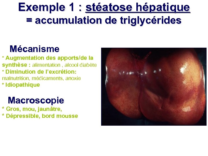 Exemple 1 : stéatose hépatique = accumulation de triglycérides - Mécanisme * Augmentation des