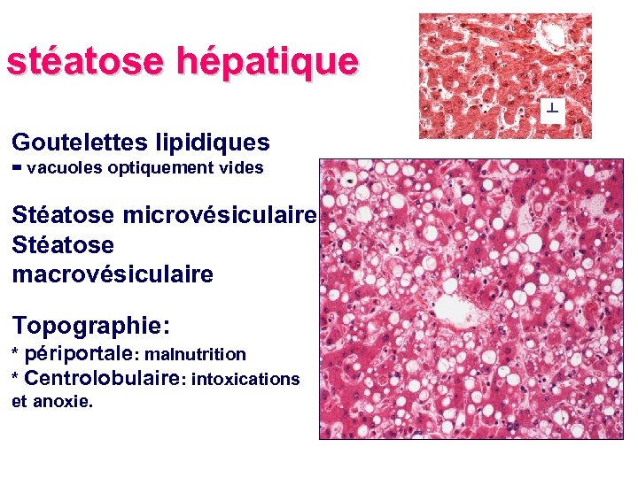 stéatose hépatique ┴ Goutelettes lipidiques = vacuoles optiquement vides Stéatose microvésiculaire Stéatose macrovésiculaire Topographie: