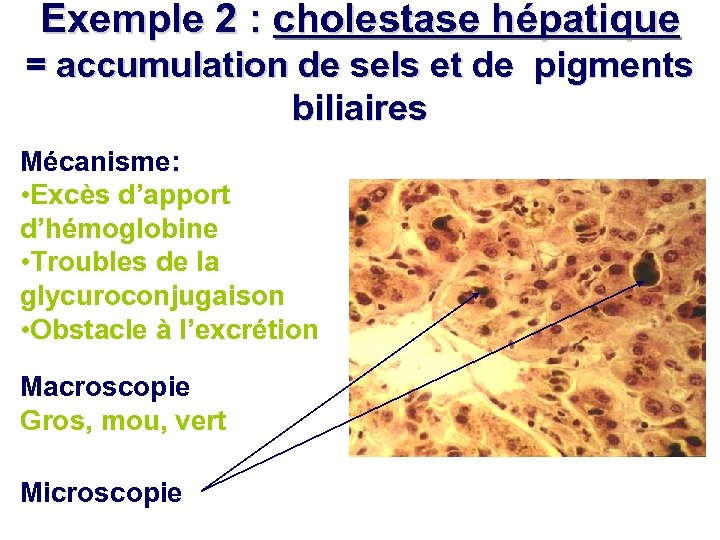 Exemple 2 : cholestase hépatique = accumulation de sels et de pigments biliaires Mécanisme: