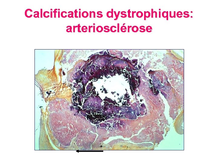 Calcifications dystrophiques: arteriosclérose 