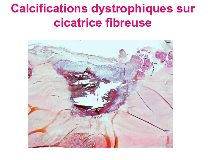 Calcifications dystrophiques sur cicatrice fibreuse Calcification sur tissu fibreux cicatriciel 