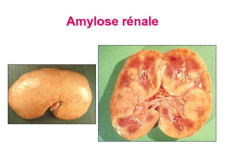 Amylose rénale 