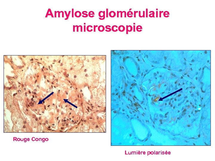 Amylose glomérulaire microscopie Rouge Congo Lumière polarisée 