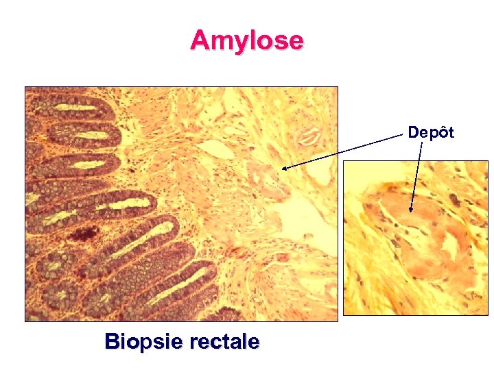 Amylose Depôt Biopsie rectale 