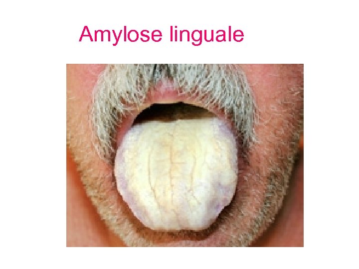 Amylose linguale 