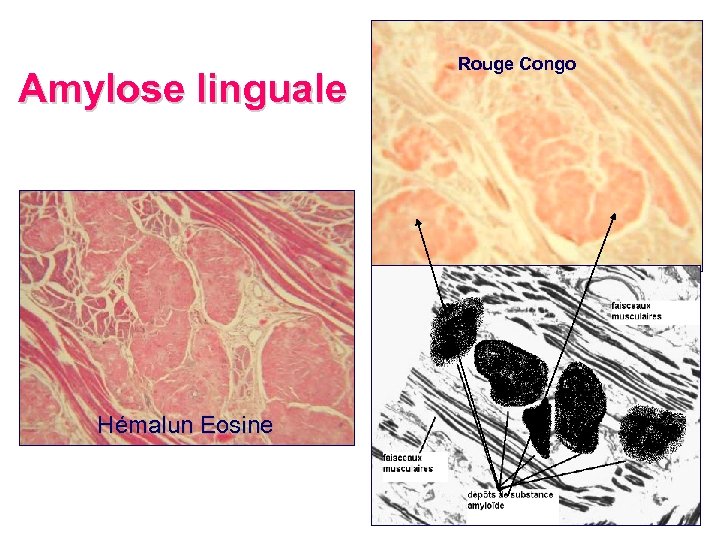 Amylose linguale Hémalun Eosine Rouge Congo 