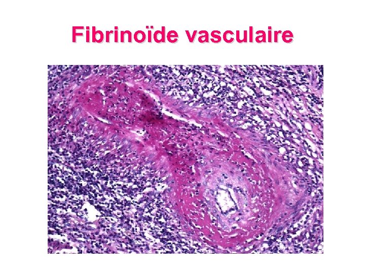 Fibrinoïde vasculaire 