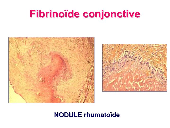 Fibrinoïde conjonctive NODULE rhumatoïde 