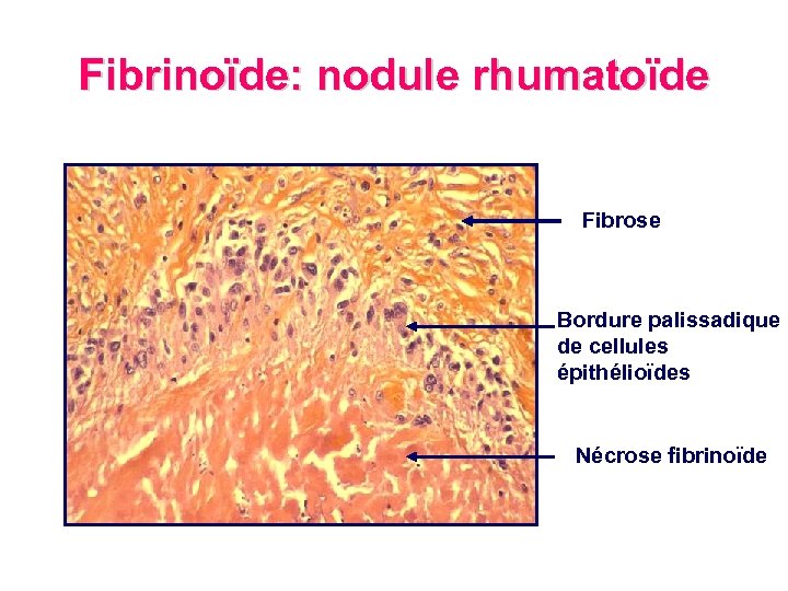 Fibrinoïde: nodule rhumatoïde Fibrose Bordure palissadique de cellules épithélioïdes Nécrose fibrinoïde 
