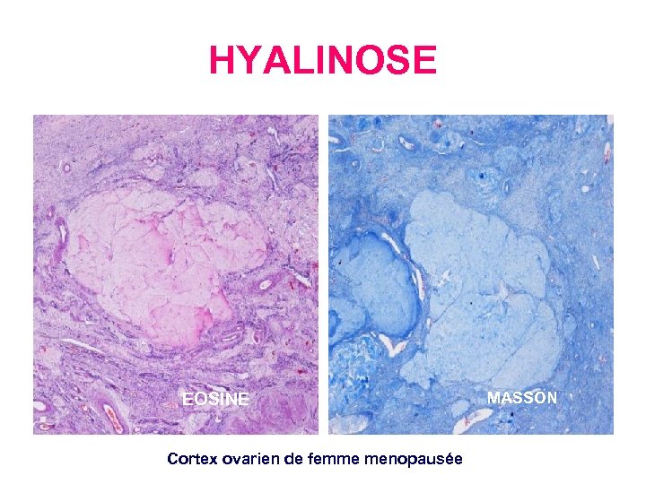HYALINOSE EOSINE Cortex ovarien de femme menopausée MASSON 