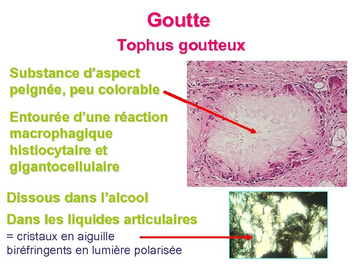 Goutte Tophus goutteux Substance d’aspect peignée, peu colorable Entourée d’une réaction macrophagique histiocytaire et