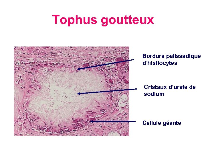 Tophus goutteux Bordure palissadique d’histiocytes Cristaux d’urate de sodium Cellule géante 