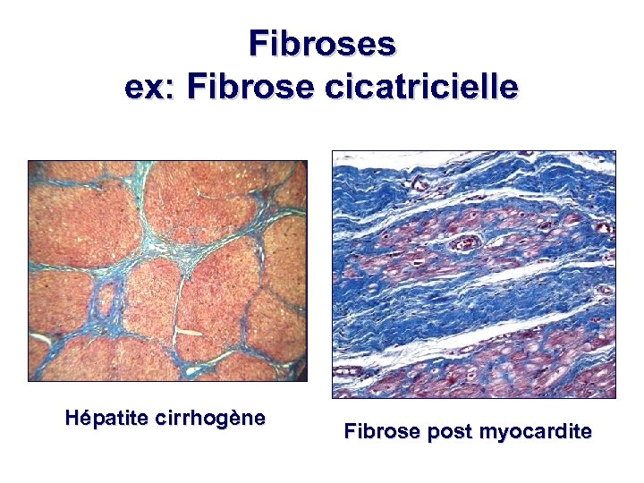 Fibroses ex: Fibrose cicatricielle Hépatite cirrhogène Fibrose post myocardite 