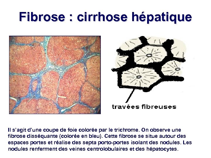 Fibrose : cirrhose hépatique Il s’agit d’une coupe de foie colorée par le trichrome.