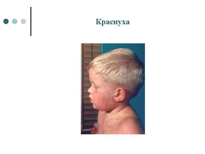 Краснуха 