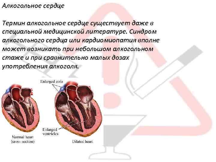 Алкогольное сердце Термин алкогольное сердце существует даже в специальной медицинской литературе. Синдром алкогольного сердца