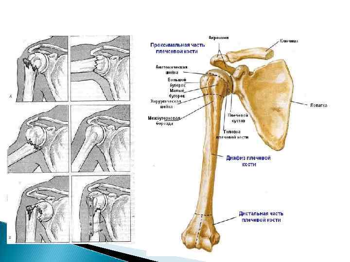 Гребне плечевой кости. Анатомия проксимального отдела плечевой кости. Отрыв малого бугорка плечевой кости. Импрессионный перелом большого бугорка левой плечевой кости.
