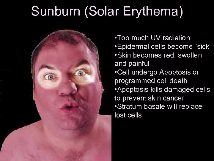 Sunburn (Solar Erythema) • Too much UV radiation • Epidermal cells become “sick” •