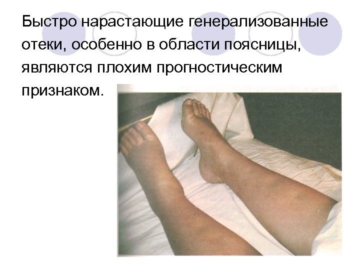 Быстро нарастающие генерализованные отеки, особенно в области поясницы, являются плохим прогностическим признаком. 