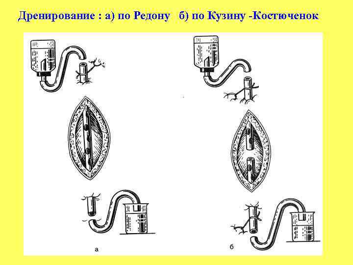 Дренирование : а) по Редону б) по Кузину Костюченок 
