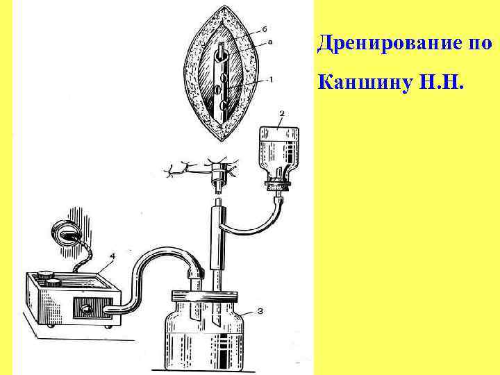 Дренирование по Каншину Н. Н. 