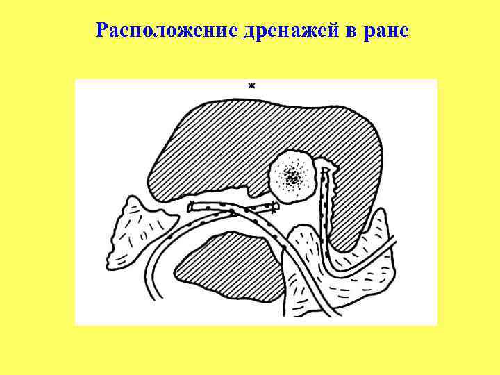Расположение дренажей в ране 