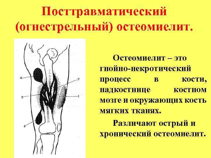 Посттравматический (огнестрельный) остеомиелит. Остеомиелит – это гнойно некротический процесс в кости, надкостнице костном мозге