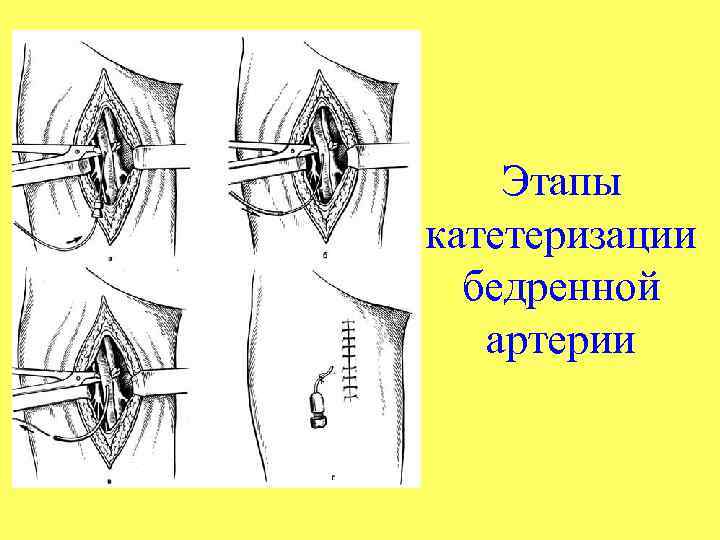Этапы катетеризации бедренной артерии 