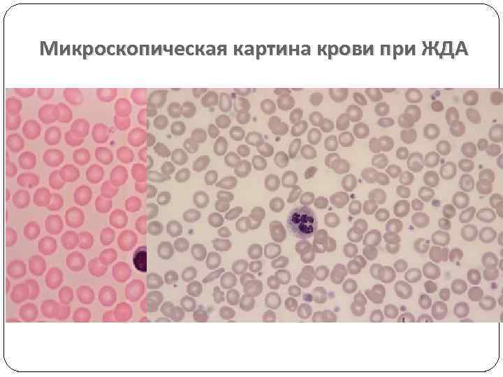 Микроскопическая картина крови при ЖДА 