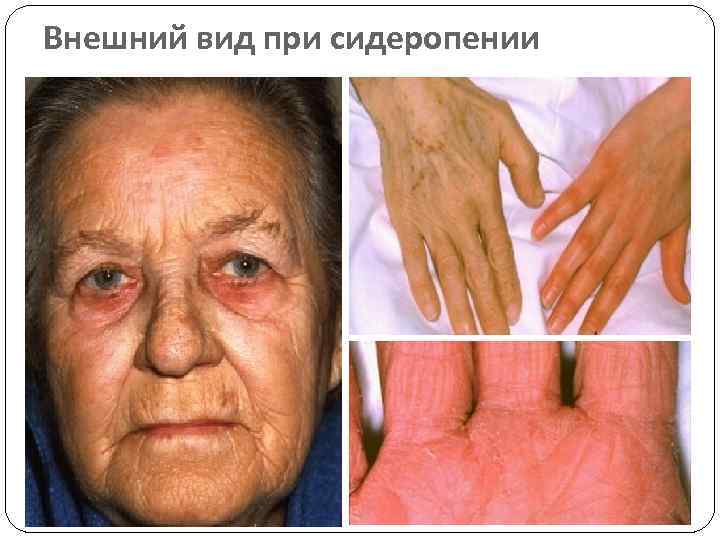 Внешний вид при сидеропении 