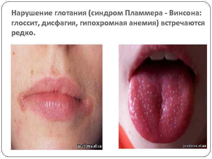 Нарушение глотания (синдром Пламмера - Винсона: глоссит, дисфагия, гипохромная анемия) встречаются редко. 