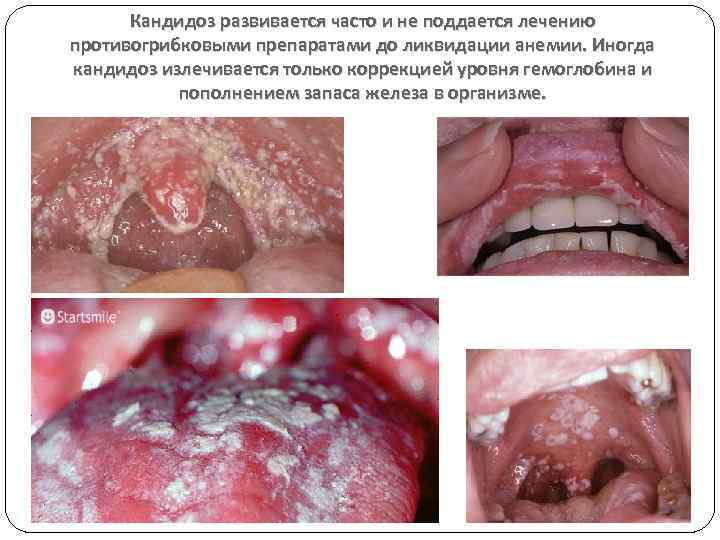 Кандидоз развивается часто и не поддается лечению противогрибковыми препаратами до ликвидации анемии. Иногда кандидоз