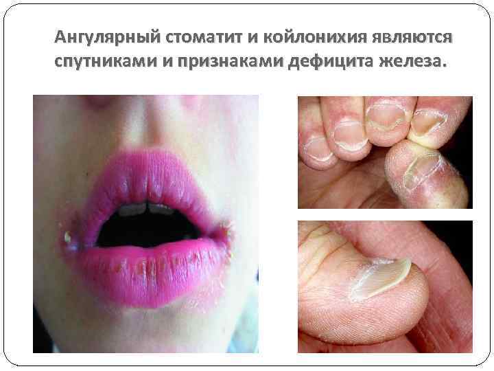 Ангулярный стоматит и койлонихия являются спутниками и признаками дефицита железа. 
