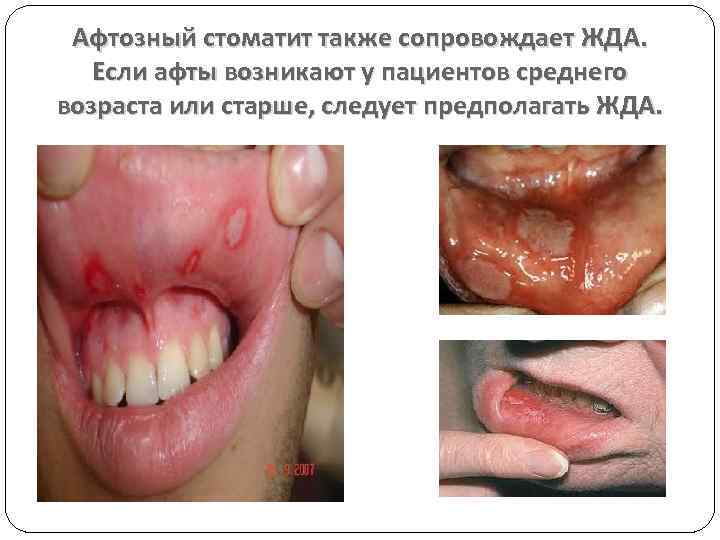 Афтозный стоматит также сопровождает ЖДА. Если афты возникают у пациентов среднего возраста или старше,