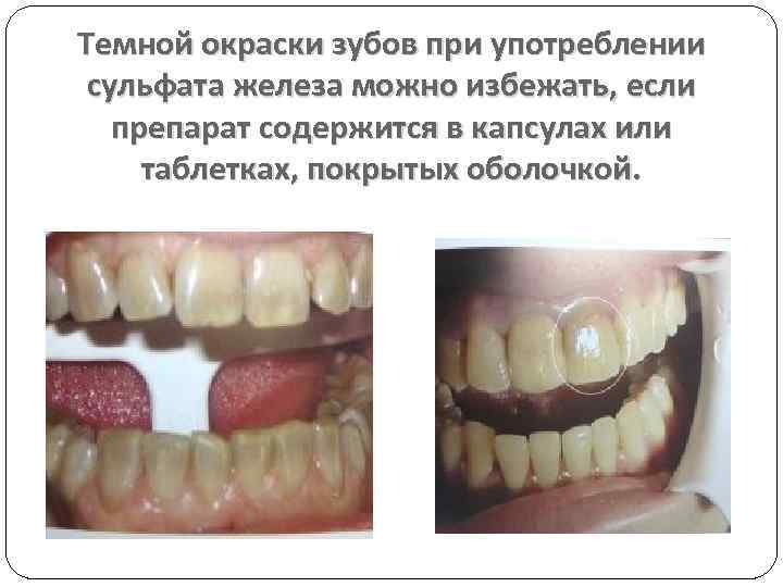 Темной окраски зубов при употреблении сульфата железа можно избежать, если препарат содержится в капсулах