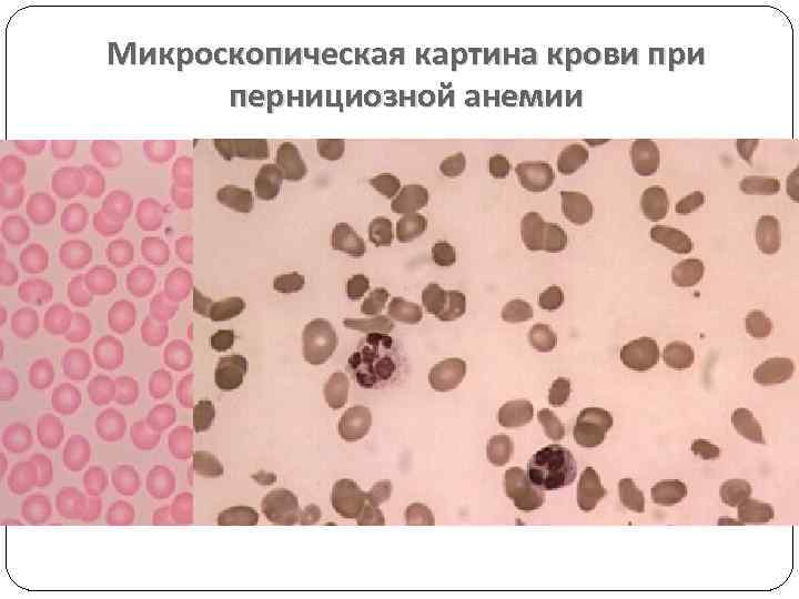 Микроскопическая картина крови при пернициозной анемии 