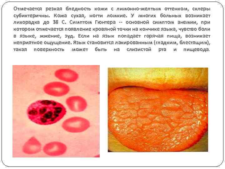 Отмечается резкая бледность кожи с лимонно-желтым оттенком, склеры субиктеричны. Кожа сухая, ногти ломкие. У