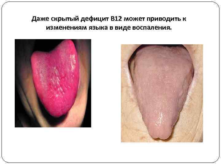 Даже скрытый дефицит В 12 может приводить к изменениям языка в виде воспаления. 