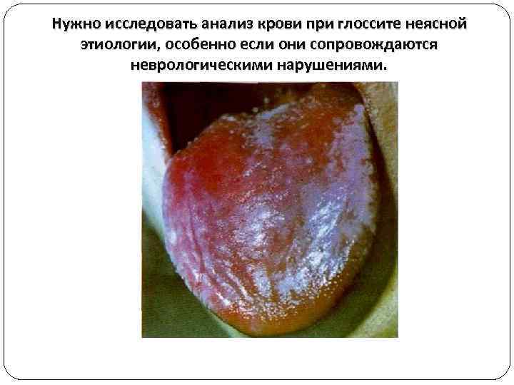 Нужно исследовать анализ крови при глоссите неясной этиологии, особенно если они сопровождаются неврологическими нарушениями.