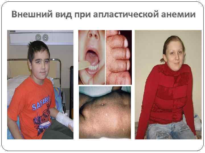 Внешний вид при апластической анемии 